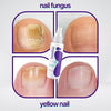 ZAMORA MART Nail Fungus Spray in a white bottle with a spray nozzle, designed to treat nail fungus infections.